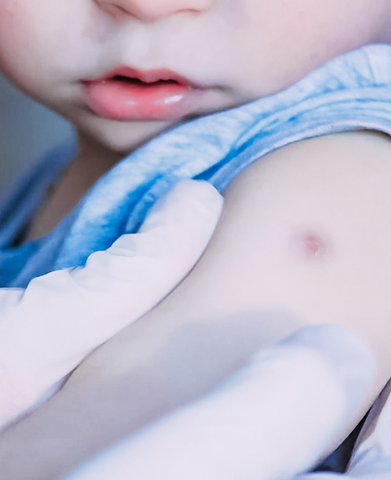 Doctor wearing white latex gloves examines vaccination site on upper arm of small child
